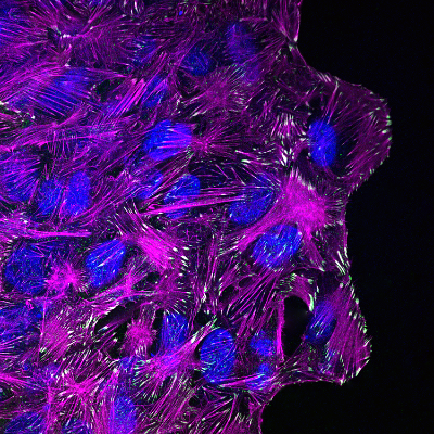 9. Cellules cancéreuses en mouvement.... item