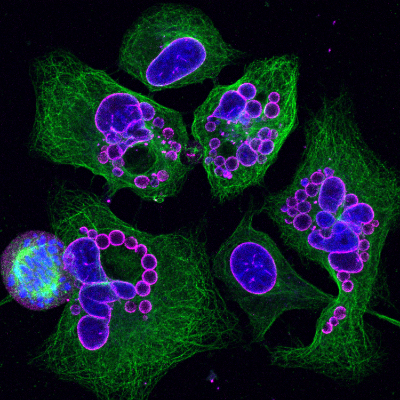 21. Cellules d'ostéosarcome en folie item