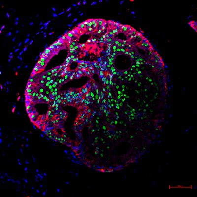 11. Cancer Abyss item